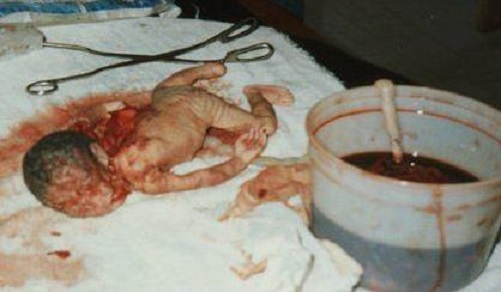 abortion - baby on table top